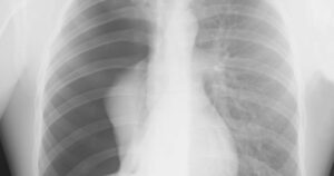 Pneumothorax Types